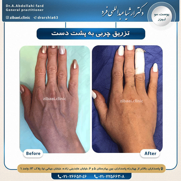 تزریق چربی- دکتر عبداللهی فرد