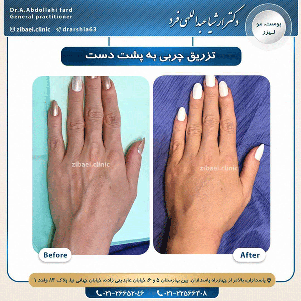 تزریق چربی- دکتر عبداللهی فرد