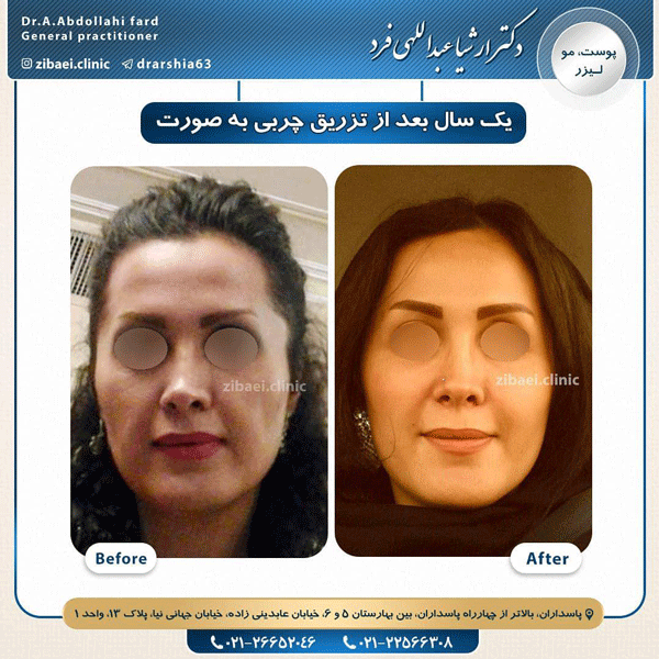 تزریق چربی-دکتر ارشیا عبداللهی فرد