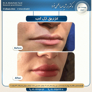 تزریق ژل - دکتر عبداللهی فرد