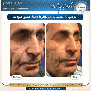تزریق ژل - دکتر عبداللهی فرد