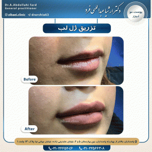 تزریق ژل - دکتر عبداللهی فرد