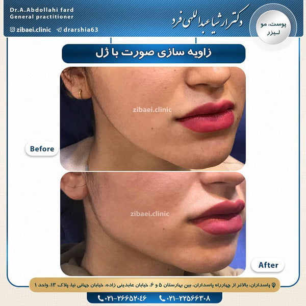 جوانسازی