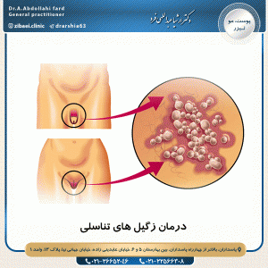 درمان زگیل های تناسلی