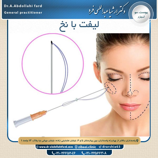 لیفت با نخ - دکتر عبداللهی فرد