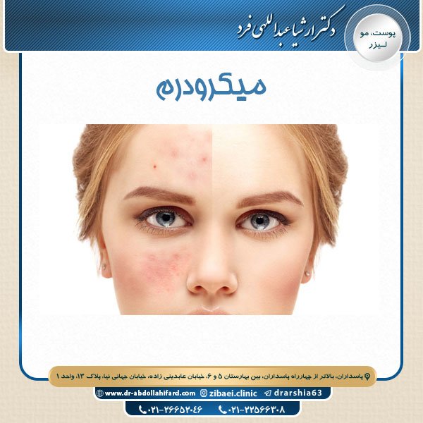 میکرودرم