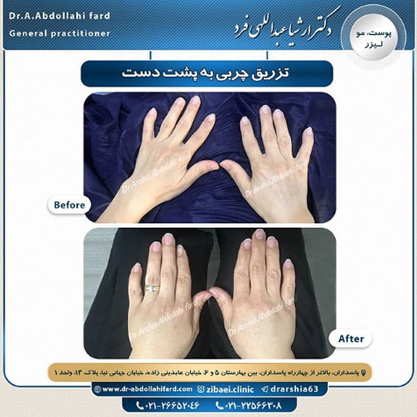 تزریق چربی به دست