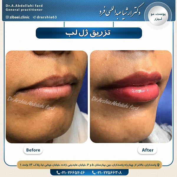 تزریق ژل لب - دکتر ارشیا عبداللهی فرد