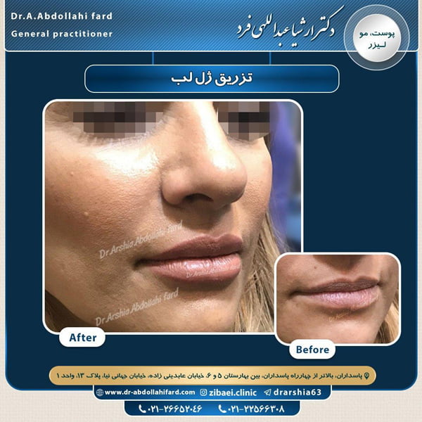 تزریق ژل لب - دکتر عبداللهی فرد