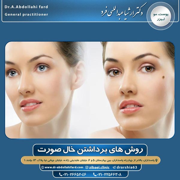 برداشتن خال
