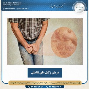 درمان زگیل های تناسلی