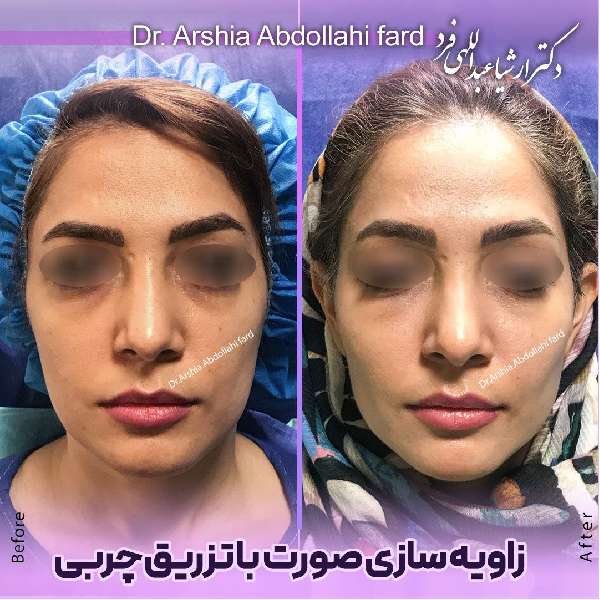 عکس زاویه سازی فک