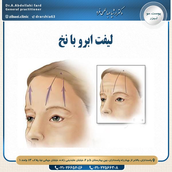 لیفت ابرو با نخ