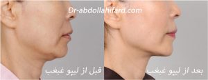 عکس قبل و بع داز لیپو غبغب - دکتر عبداللهی فرد