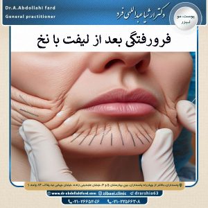 فرورفتگی بعد از لیفت با نخ | دکتر عبدالهی فرد