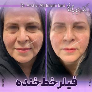 عکس تزریق ژل به صورت - دکتر عبداللهی فرد 
