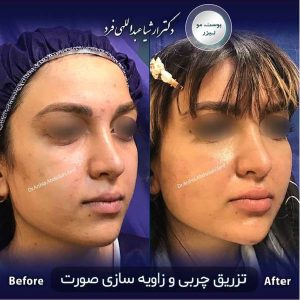 عکس تزریق چربی به صورت - دکتر عبداللهی فرد