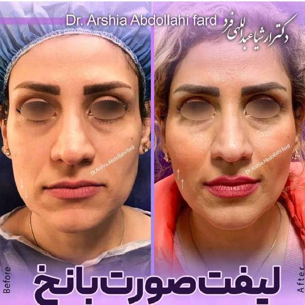 لیفت صورت با نخ