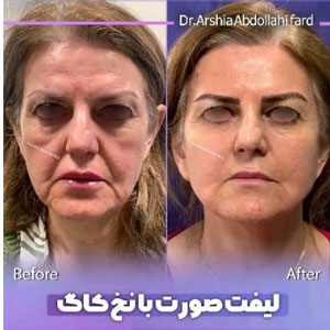 لیفت صورت با نخ کاگ