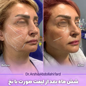 نتایج لیفت با نخ در تهران