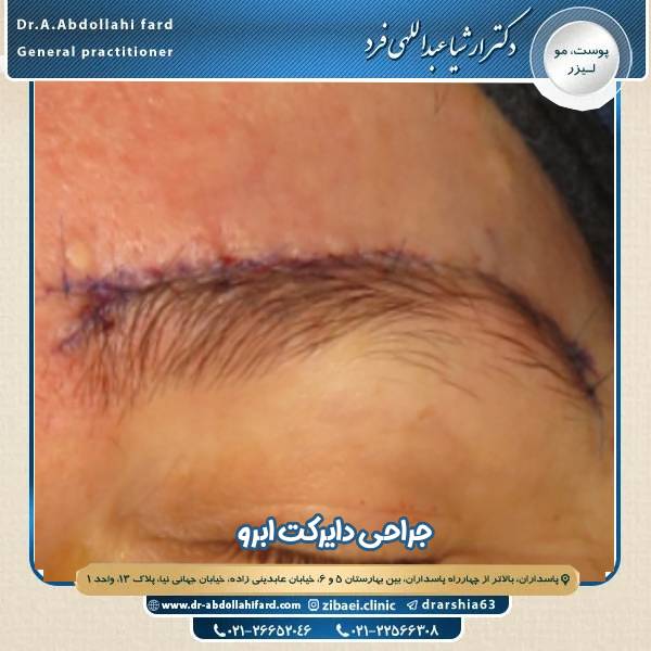 دایرکت ابرو