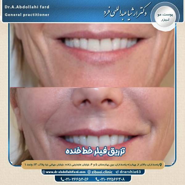 تزریق فیلر خط خنده