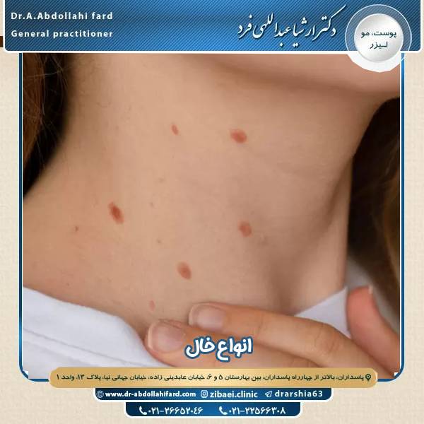 انواع خال