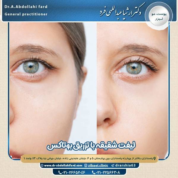 لیفت شقیقه با بوتاکس