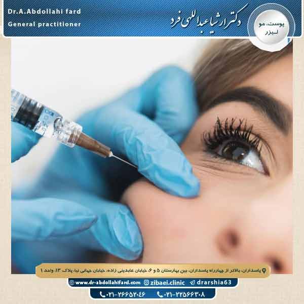 بوتاکس گونه