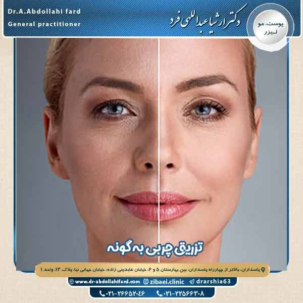 تزریق چربی به گونه