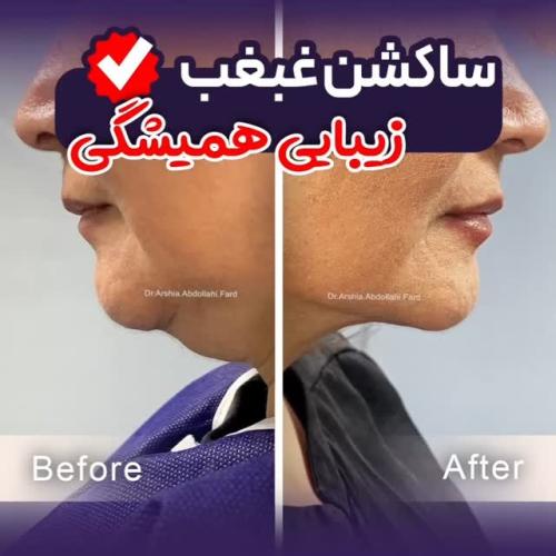 1-تخیله-چربی