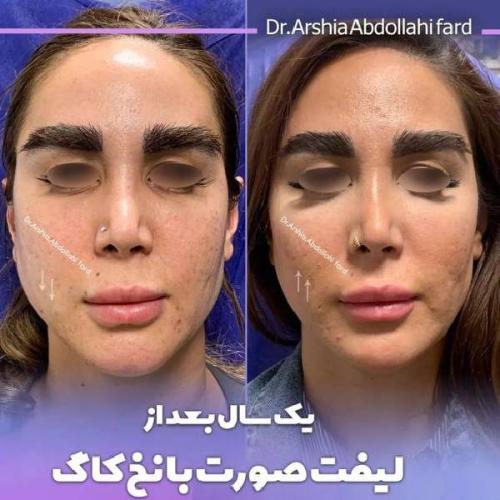 لیفت صورت 2