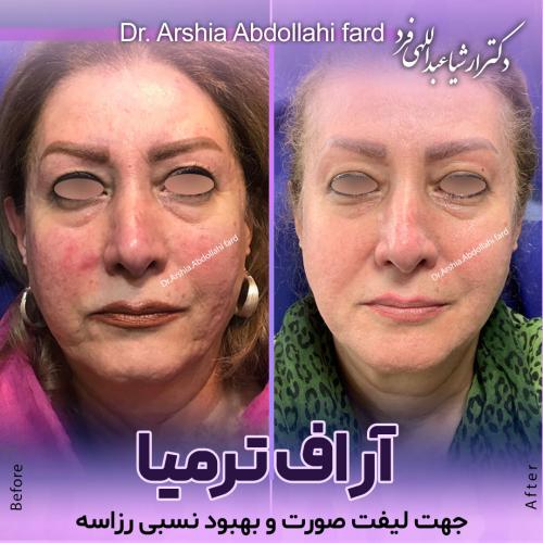 آر-اف-ترمیا-82