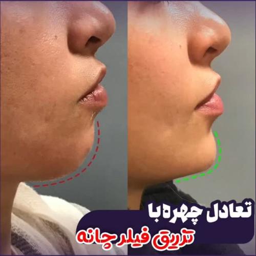 تخیله-چربی-2