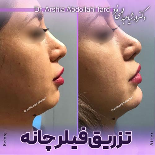 تزریق-فیلر-چانه-در-تهران-102