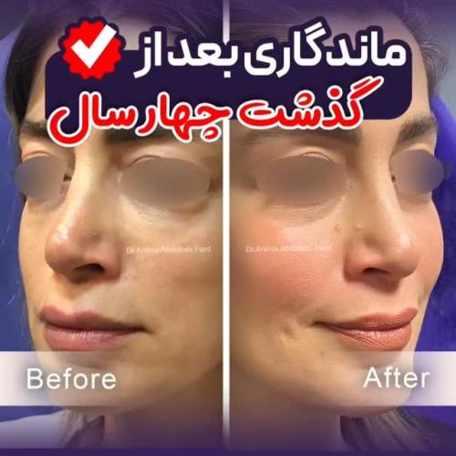تزریق-چربی-در-تهران-84