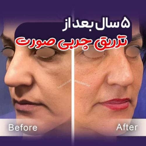 تزریق-چربی-در-تهران-85
