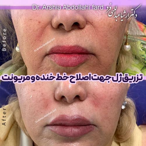 تزریق-ژل-در-تهران-98