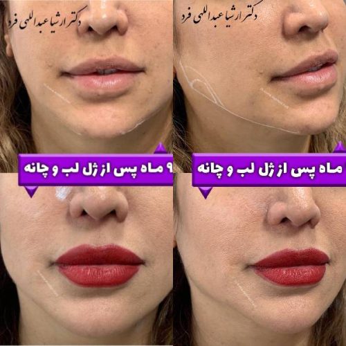 تزریق-ژل-در-تهارن-123