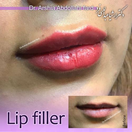 تزریق-ژل-در-تهران-103