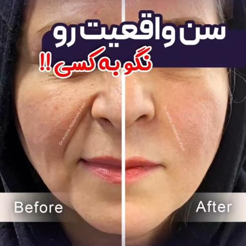 تزریق-ژل-در-تهران-107-