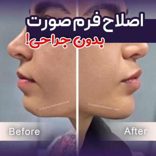 تزریق-ژل-در-تهران-109-
