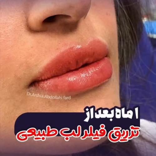 تزریق-ژل-در-تهران-115