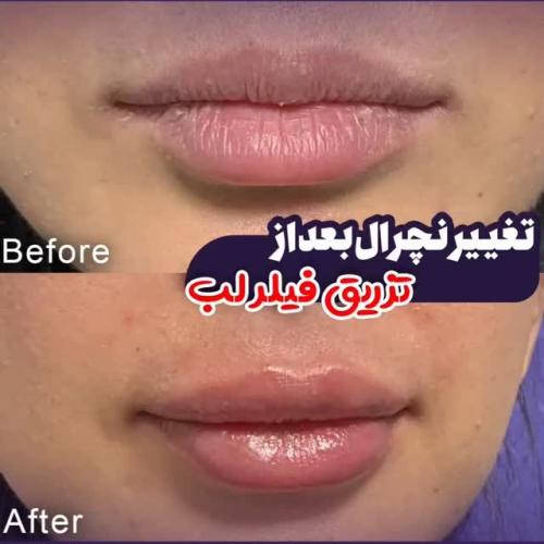 تزریق-ژل-در-تهران-116