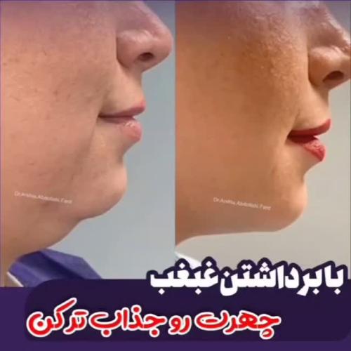 تزریق-ژل-در-تهران-117-
