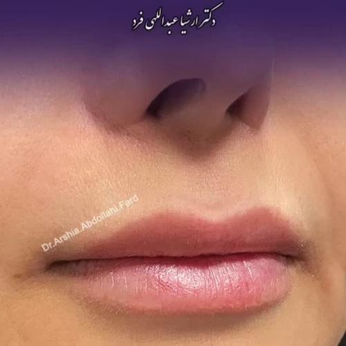 تزریق-ژل-در-تهران-118