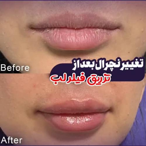 تزریق-ژل-در-تهران-119