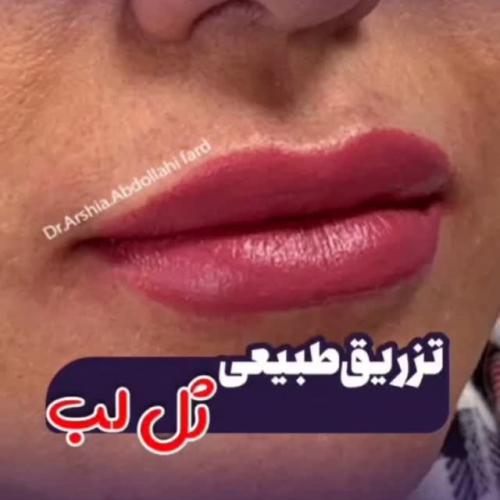 تزریق-ژل-در-تهران-120