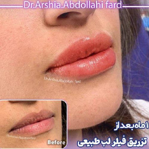تزریق-ژل-در-تهران-122