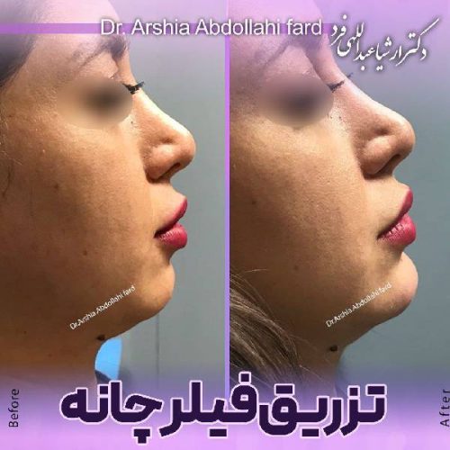 تزریق-ژل-در-تهران-124